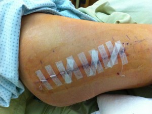 DebbyK's battle scar