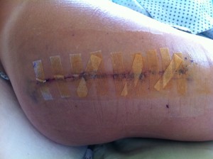 DebbyK Day 3 Post Op Surgical Scar