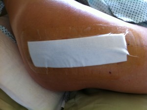 DebbyK Day 3 Post Op Surgical dressing